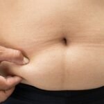 Belt Lipectomy