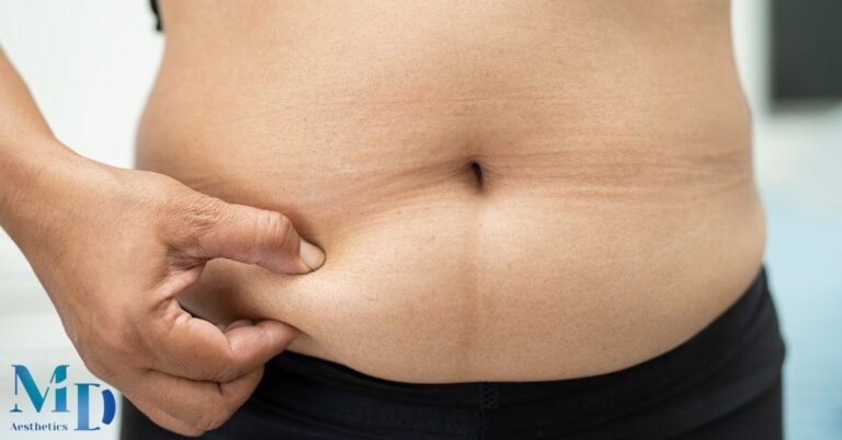 Belt Lipectomy